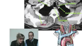 Endokrin Cerrahide Boyun ve Toraks BT Yorumlaması [upl. by Ricker29]