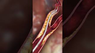 Carotid embolic prevention  animationshorts shortsfeed youtubeshorts viralshorts [upl. by Retepnhoj]