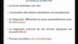 Sarcoïdose Atypique avec Atteinte Multisystémique  H Kwas [upl. by Annwahs]