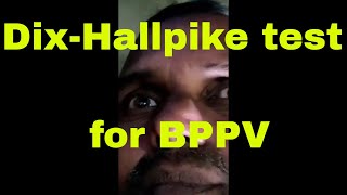 DixHallpike testmanoeuvre for BPPV Benign Paroxysmal Positional Vertigo [upl. by Soneson122]