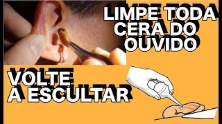 LIMPE TODA CERA DO OUVIDO E VOLTE A ESCUTAR FACIL E RAPIDO [upl. by Nette]