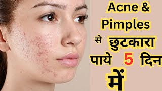 कील मुहासो acne की दवा Clindamycin phosphate gel  usesmechanism of action  Clinsol Gel review [upl. by Clute]