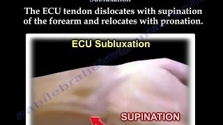 Extensor Carpi Ulnaris Subluxation  Everything You Need To Know  Dr Nabil Ebraheim [upl. by Schweiker776]