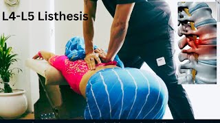 HOW TO TREAT BACKPAINL4L5 Anterolisthesis Best Chiropractor in India Immediate relief [upl. by Cerallua]