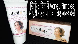 Clincitop Gel For Acne Pimples Remover Full Review By Anmol Hindi [upl. by Dmitri779]