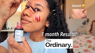 The Ordinary Peeling Solution before and after Review 12 weeks [upl. by Corina95]