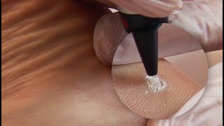 Plantar Wart Treatment [upl. by Bella]