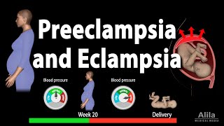 Preeclampsia and Eclampsia Animation [upl. by Ydda]