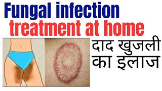 Fungal infection treatment at home  Khujli ki medicine  Daad ki best medicine [upl. by Ruthann]