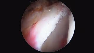 Hip Arthroscopy  Pincer resection FAI by Dr Andrew Dold MD [upl. by Obe]