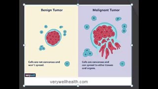 Pathology 192 a Define Benign Malignant Tumor Neoplasia Differences Compare Comparison Vs [upl. by Ahsinad]