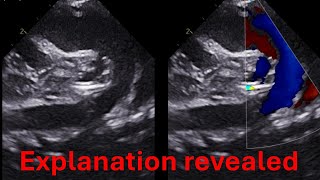 Truncus arteriosus  single ventricle and more  Explanation of case 1 [upl. by Nylyoj]