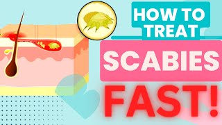 HOW TO TREAT SCABIES FAST TREATMENT AND HOME REMEDIES [upl. by Aidni]