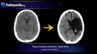 Stroke Evolution from acute to chronic infarction  radiology video tutorial CT MRI [upl. by Anirehc]