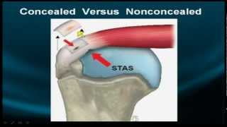 Shoulder MRI Rotator Cuff  Part IIa [upl. by Ellenehs]