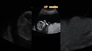 Ultrasound Scan Of 17 Week Old Fetus shorts babygirl ultrasound [upl. by Zulch]