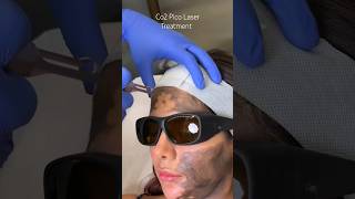 Co2 Pico Laser Treatment at CARA [upl. by Reichel412]