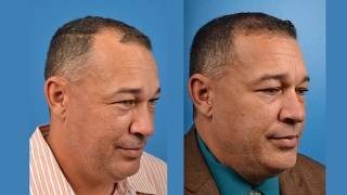 NeoGraft Hair Restoration How Kamen Got His Hair Back  Dr Ross Clevens Melbourne FL [upl. by Ebony]