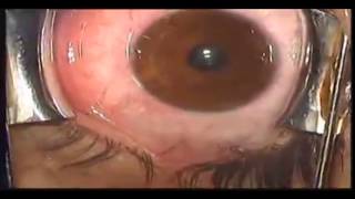 Eye Color Modification with iris implant Brightocular [upl. by Quartet36]