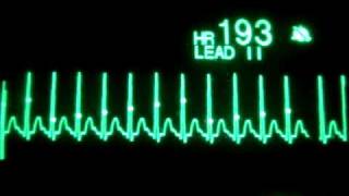 Supraventricular Tachycardia with Synchronized Cardioversion [upl. by Nadirehs237]