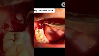 🦷WISDOM TOOTH EXTRACTION 🦷 Dr  Sabih khan👨‍⚕️ 😊 smile N cure dental clinic😊 [upl. by Rennat]