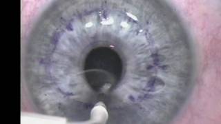 Conductive Keratoplasty [upl. by Charleton]