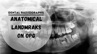 Dental panoramic radiographs  OPG  DPT Anatomical Landmarks [upl. by Rolat932]