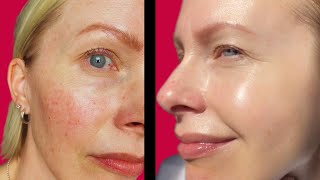 ROSACEA  How to calm amp soothe skin [upl. by Worsham376]