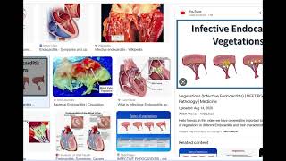 Infective endocarditis High yield concepts [upl. by Marino]