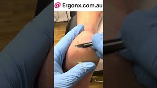 Cracked heel treatment by podiatrist in clinic ergonxcomau satisfying do you get cracked [upl. by Desmond515]