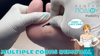 Corns Removal P1 feet κεντροποδιου foot podologos podiatrist corn footcare podiatry callus [upl. by Danaher846]