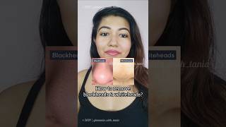 Blackheads removal tips shorts skincare affordable diy tips blackheads makeup [upl. by Ydnam]