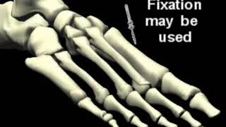 Weil Lesser Metatarsal Osteotomy Severe hammertoe correction procedure [upl. by Ranchod]