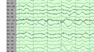 EEG basics [upl. by Jones]