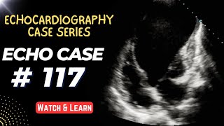 ECHO CASE 117  Echocardiography For Beginners  Echocardiogram Cases [upl. by Gnes]