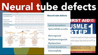 Neural tube defects Spina bifida occulta Meningocele Myelomeningocele Myeloschisis Anencephaly [upl. by Rep820]