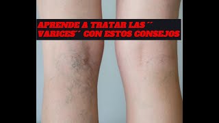 APRENDE A TRATAR LAS ´´VARICES´´ CON ESTOS CONSEJOS CASEROS [upl. by Daffodil286]