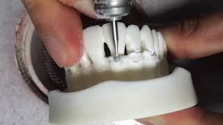 radicular blending amp marginal bone gradualizaion for Crown Lengthening or Alveoloplasty [upl. by Sitruc862]