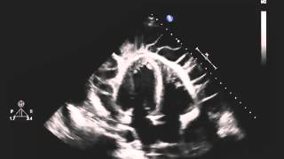 Echocardiogram of a Patient with Uremic Pericarditis [upl. by Averir]