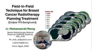 Field in Field Technique for Breast Cancer Radiotherapy Planning Treatment [upl. by Aneehsyt230]