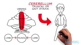 Neurology – Ataxia Gait – By Wendy Stewart MD [upl. by Edas]