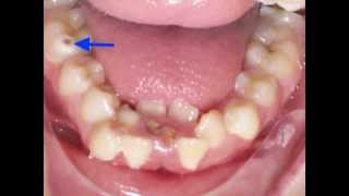 Lower Incisor Extraction Time Lapse Video Kyger Orthodontics [upl. by Bills]