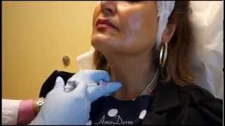 Neck Platysmal Band Treatment with Botox [upl. by Ezra]