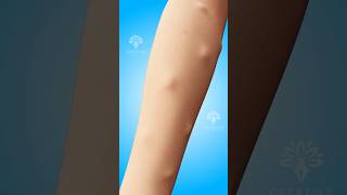 Why Do Lipomas Form Under Your Skin shorts viralvideo lipomas  Creativelearning3d [upl. by Coveney]