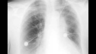 Left Upper Lobe Atelectasis on Chest X ray [upl. by Nerej]