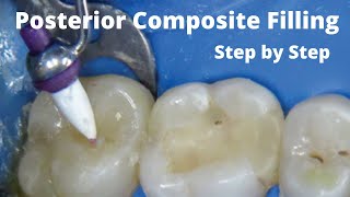 Posterior Molar Composite Esthetic Filling by dentsply Spectra St review Step by Step Dental Filling [upl. by Tandi]