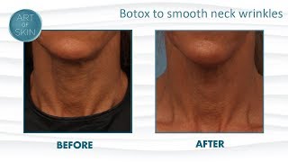 Botox To Lift Neck And Smooth Wrinkles [upl. by Aribold]