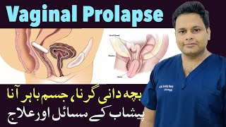 Vaginal Prolapse  Cystocele  Bacha Dani Ka Jism Se Baher Aana  Bacha Dani Gir jana [upl. by Akimat]