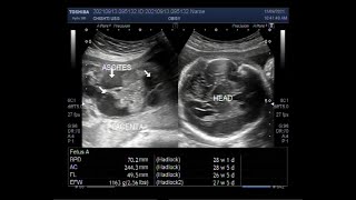 Fetal ascites Fetal hydronephrosis Pericardial effusion and dilated brain ventricles [upl. by Neirbo657]