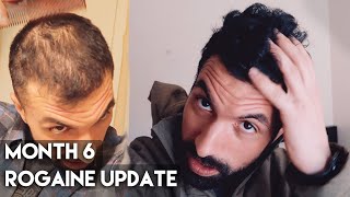 6 Month Rogaine Results Minoxidil [upl. by Inalan]